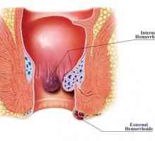 Хемороиди: причини за мъжете, симптоми и характеристики на лечението