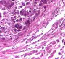 Хепатоцелуларен карцином на черния дроб: диагноза, симптоми и лечение