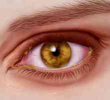 Херпес на окото: лечение, причини, лекарства