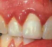 Гингивит: какво да изплакнете устата си с възпаление на венците?