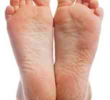 Хиперкератоза на краката: лечение с народни средства