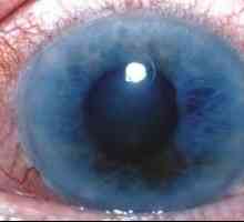 Глаукома: лечение при първите признаци на заболяването
