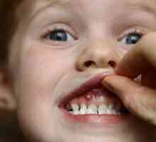 Язви на венците в детето: причини и лечение