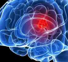 Главоболие: мозъчен тумор. Първите симптоми на мозъчен тумор