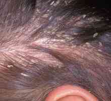 Гъбична кожа на главата: симптоми и лечение