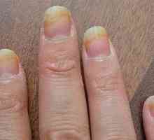 Храносмилане на ноктите на ръцете: описание на болестта и лечение