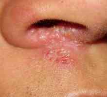 Гъби в носа: симптоми, лечение, снимка