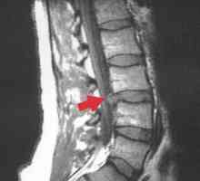 Хернизиран диск на гръбначния стълб