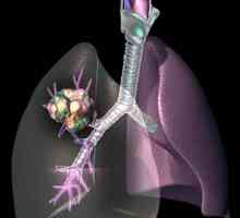 Химиотерапия за рак на белите дробове. Как да се лекува рак на белия дроб