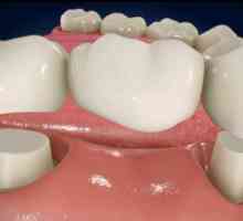 Имплант или мост - кое е по-добре? Зъбни импланти. Зъбна протеза
