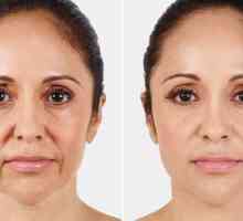 Инжектиране на колаген за лицето: рецензии