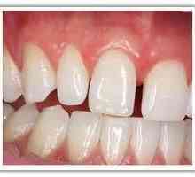 Корекция на оклузията при възрастни. Здрави зъби - красиви зъби