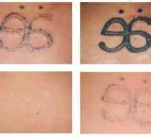 Отърви се от грешките от миналото: лазерно отстраняване на татуировки