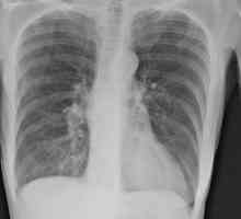 Емфизем на белите дробове: лечение и прогноза