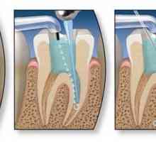 Ендодонтско лечение на зъбите. Етапи на ендодонтско лечение