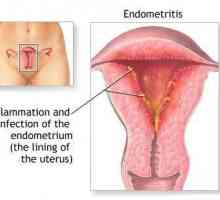 Ендометрия на матката - какво е това? Симптомите на ендометрията при жените. Гинекология -…