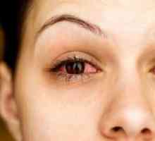 Епискрилит на окото: признаци, причини, лечение