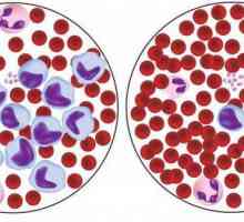 Еритетроцитите в кръвта се понижават: възможни причини