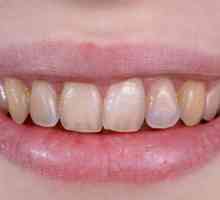 Ерозия на зъбите: описание, причини, симптоми и особености на лечението