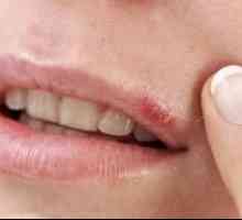 Как бързо да се излекува херпес на устните: съвет от традиционната медицина