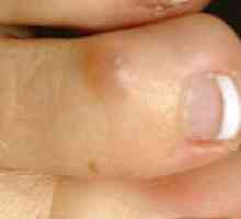 Как да се третира сухият калус на пръстите? Мазилка върху сухи корнизи
