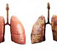 Как правилно да се лекува възпалението на белите дробове