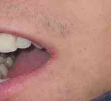 Как да се лекува снакс в ъглите на устните по народни начини и с помощта на лекарства