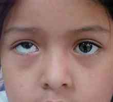 Каква е името на болестта, когато очите изглеждат в различни посоки?