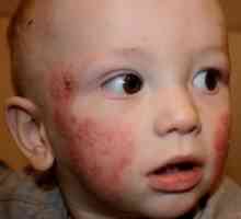 Как се развиват кожните заболявания при децата