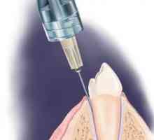 Как действа ultracaine в стоматологията?