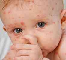 Как се развива детето варицела? Първи признаци
