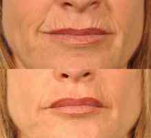 Как да премахнете бръчките над горната устна: прегледи на козметиците. Как да премахнете бръчките…