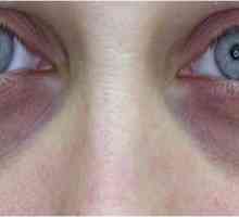 Как да почистите синините под очите? Разглеждаме ефективни методи