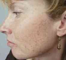 Как да премахнете пигментните петна по лицето: народни средства