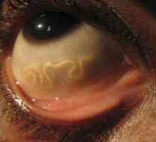 Какви са паразитите в очите на човека?