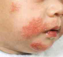 Какво трябва да бъде лекарството за деца от алергии