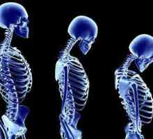 Кой лекар третира остеопорозата? Остеопороза: симптоми, причини, лечение и профилактика