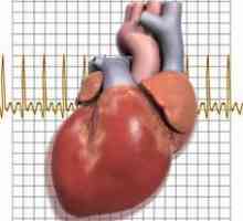 Кардиосклероза на сърцето: симптоми, лечение, причини