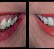 Керамични коронки на предните зъби