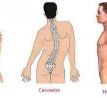 Кифосхиолиза на гръбначния стълб: видове и лечение
