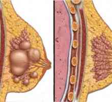 Кисти на гърдата: причини и лечение