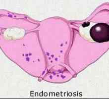 Цист на десния ендометриозен яйчник: симптоми и лечение