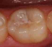Класификация на зъбния гниене. Видове и класификация на кариеса при деца