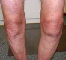 Код ICD-10: артроза на коляното