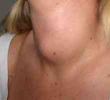 Колоиден гърч на щитовидната жлеза - какво е това? Как да се лекува колоиден гръкляр на щитовидната…