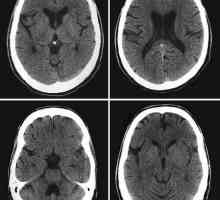 Компютърна томография на мозъка: преглед на процедурата
