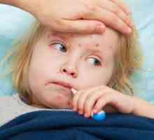 Морбили при дете: симптоми и лечение