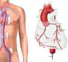 Коронарна ангиография на съдовете на сърцето: как те правят, разходите, усложненията. Коронарна…