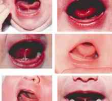 Кратка френума на езика на детето: струва ли му се да се реже?