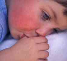 Червено петно ​​по бузата на детето: причини, прояви и характеристики на лечението